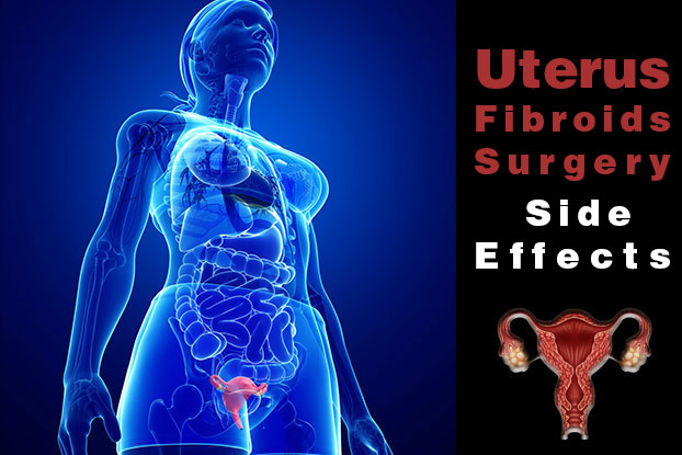 Uterus Fibroids Surgery Side Effects